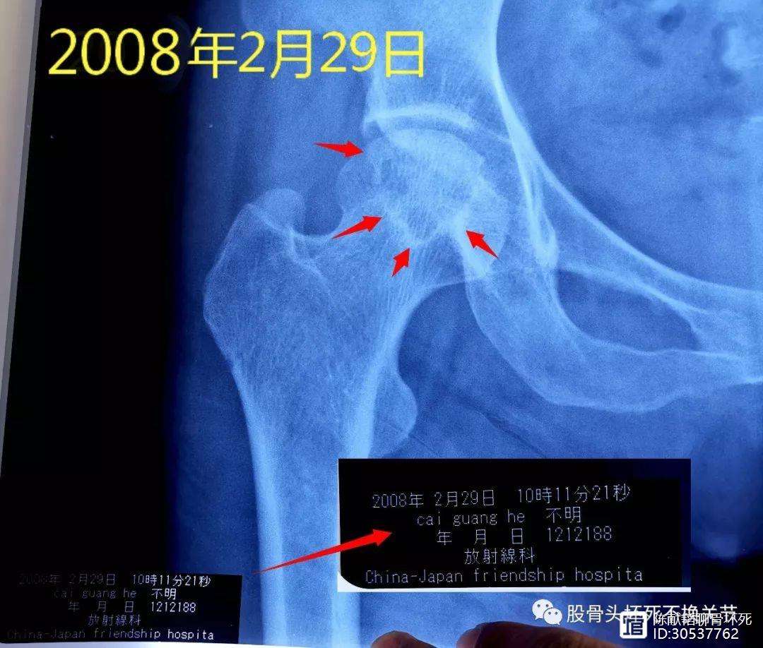 德州人工骨头医保报销多少(人工骨头医保报销多少比例)