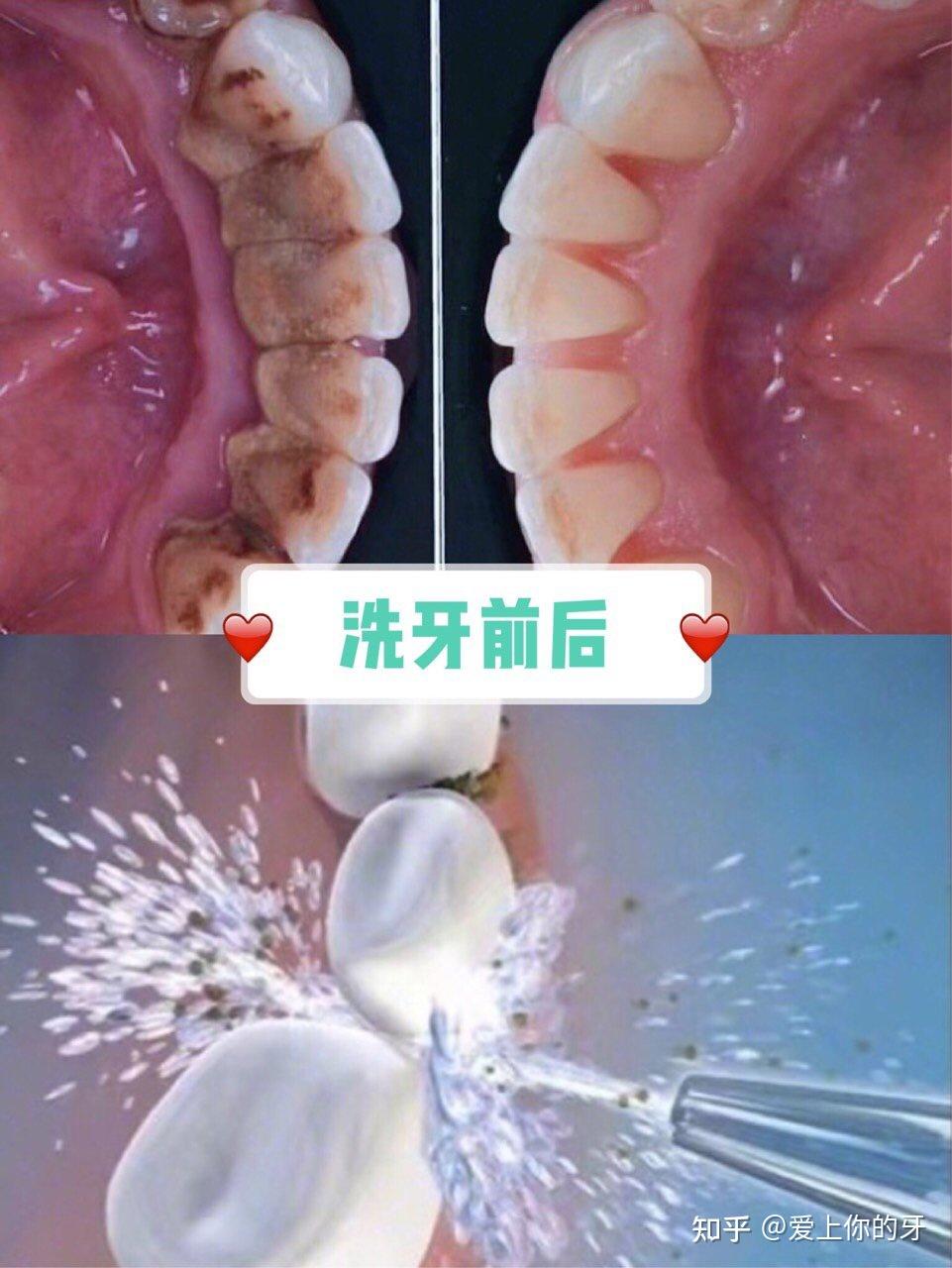 德州洗牙可以用医保吗(洗牙可以用医保吗,报销比例多少)